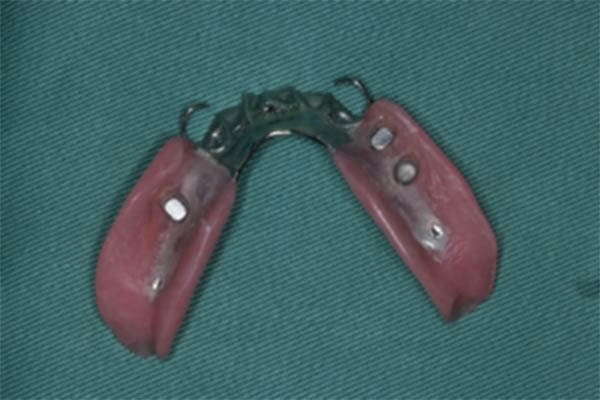 マグネット、アタッチメントを用いた義歯